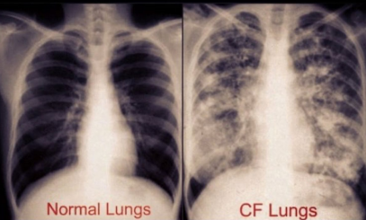 <p><strong>Cystic Fibrosis Diagnosis</strong></p><p>-Newborn screening: immunoreactive ____________ (IRT) test</p><p>-Sweat chloride test: gold standard (&gt;60 mmol/L _______ on two occasions after __________ administration confirms diagnosis)</p><p>-Genetic testing: ____ mutation analysis</p><p>-Pulmonary function tests (PFTs): shows ____________ pattern with reduced ____, irreversible</p><p>-CXR: bronchiectasis, hyperinflation of lungs</p><p>-Other labs: hyponatremia, metabolic alkalosis, elevated _______ (pancreatitis)</p>