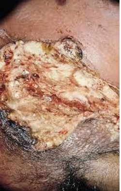 Amebiasis cutánea