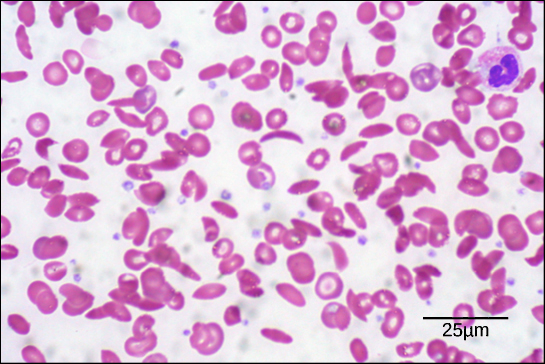 <p>A genetic condition caused by a single amino acid change in hemoglobin (the protein that carries oxygen), leading to distorted red blood cells in the shape of a crescent moon.</p>
