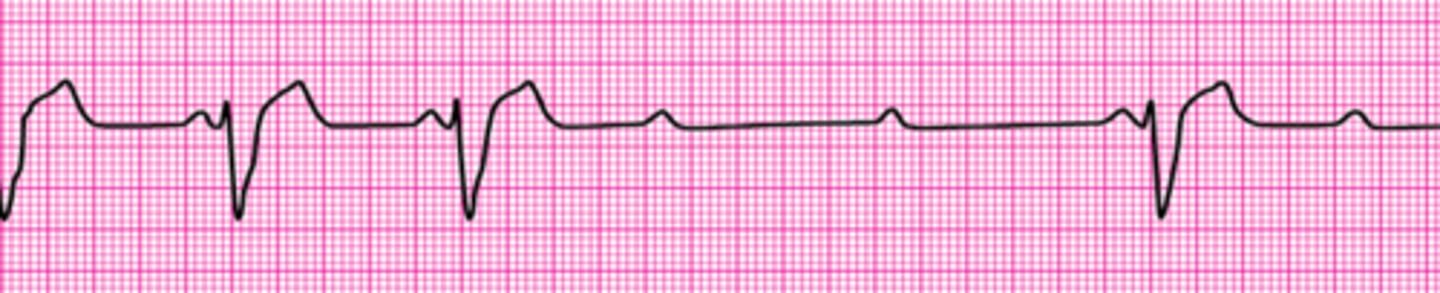 <p>Second-degree Atrioventricular Block (Mobitz II Block)</p>