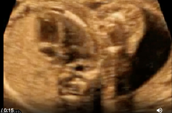 <p>a) type 1 congenital cystic adenomatoid malformation</p><p>b) diaphragmatic hernia left side</p><p>c) diaphragmatic hernia right side</p><p>d) left lung agenesis</p>