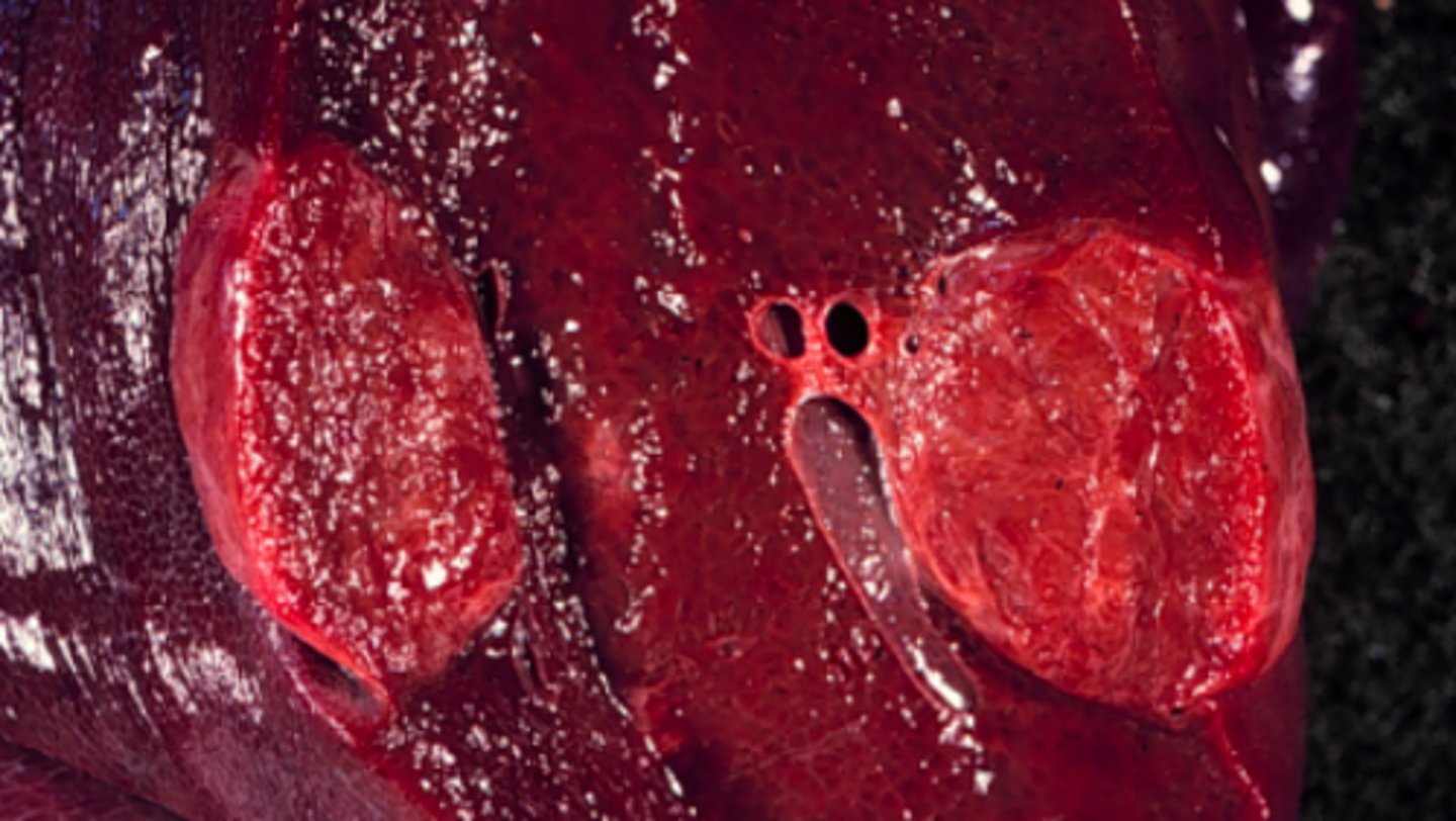 <p>Lever fra svin, hvad er den patoanatomiske diagnose?</p>