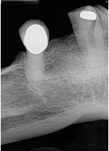 <p>How would you resolve this Foreshortening X-ray?</p>