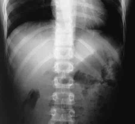 <p>What is this x-ray demonstrating?</p>