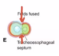 <p>when the trachea and esophagus don’t fully separate and form their own tubes</p>
