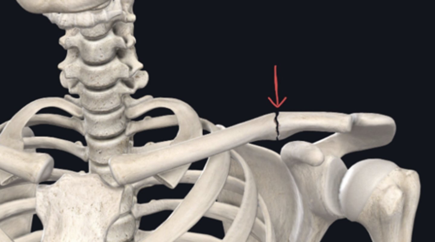 <p>Identify the plane of section in which the indicated fracture has occurred. (Free response)</p>
