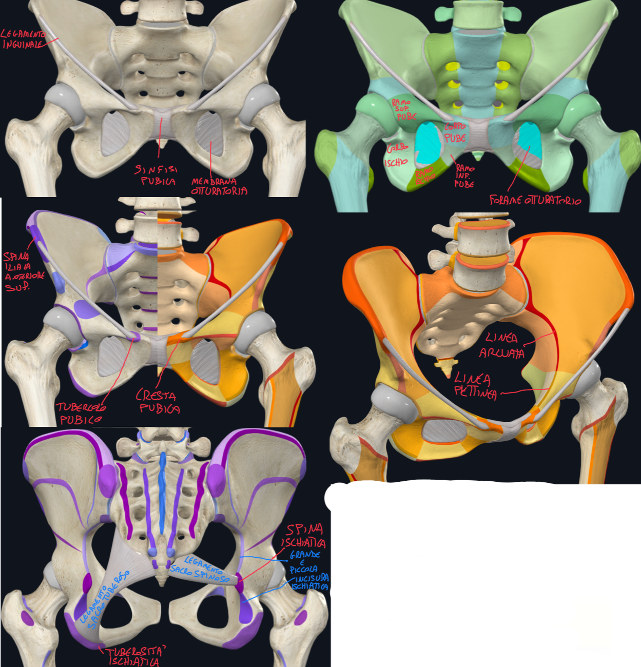 <p>ISCHIO:</p><ul><li><p>Ha una forma a L</p></li></ul><ul><li><p>Costituito da Corpo e Ramo raccordate dalla Tuberosità Ischiatica situata posteriormente.</p></li><li><p>Superiormente a quest’ultimo, abbiamo la Spina Ischiatica verso la faccia mediale, che separa la grande (superiormente) dalla piccola (inferiormente) incisura ischiatica.</p></li></ul><p>Queste incisure diventano fori grazie a due legamenti:</p><ul><li><p>Legamento Sacrospinoso → dall’osso sacro alla spina ischiatica</p></li><li><p>Legamento Sacrotuberoso → dall’osso sacro alla tuberosità ischiatica</p></li></ul><p>PUBE:</p><ul><li><p>Costituito da un Corpo e Ramo Superiore e Inferiore:</p><ul><li><p>Il ramo inferiore si fonde con il ramo dell’ischio e il ramo superiore si fonde con il corpo dell’ileo</p></li><li><p>Medialmente al corpo abbiamo la superficie sinfisaria dove si articola con il controlaterale attraverso la Sinfisi Pubica</p></li></ul></li></ul><ul><li><p>Sul margine superiore del corpo del pube abbiamo la Cresta Pubica, che termina con il Tubercolo Pubico dove si inserisce il legamento inguinale che arriva alla spina iliaca anteriore superiore</p></li><li><p>Poi dall’eminenza ileopubica al tubercolo pubico abbiamo la Linea Pettinea, come continuazione della linea arcuata dell’ileo.</p></li></ul><p>FORAME OTTURATORIO:</p><ul><li><p>Delimitato da ischio e pube</p></li><li><p>Nel vivente è chiuso dalla membrana otturatoria, con un piccolo canale per il passaggio di vasi e nervi otturatori.</p></li></ul><p></p>