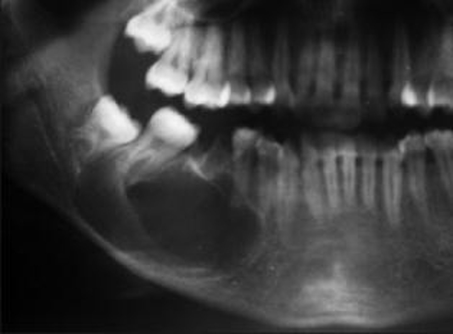 <p>• asymptomatic; painless; unencapsulated - infiltrating</p><p>• can be associated with impacted teeth</p>