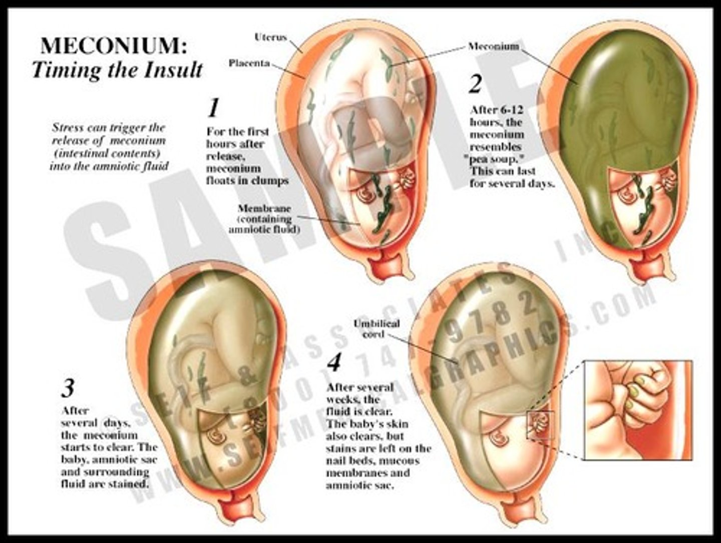 <p>Indicates that the fetus has passed stool prior to birth.</p>