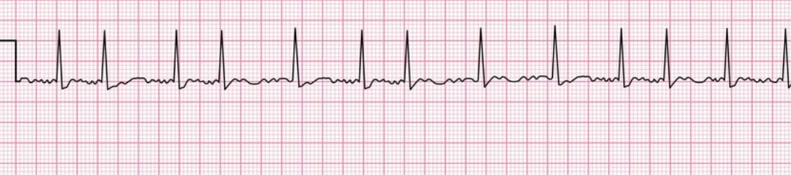 <p>A type of fast, abnormal heartbeat seen on ECG with a sawtooth appearance of P waves (F-waves) and a regular ventricular response.</p>