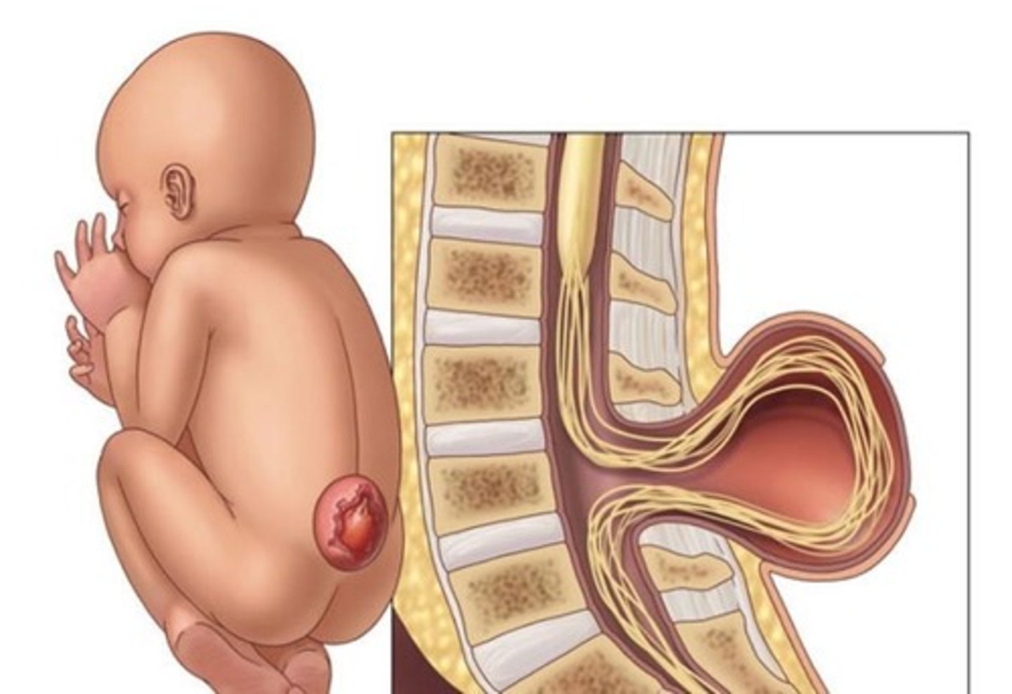 <p>Condition where 1 in 1000 born with 1+ vertebrae fail to form complete arch, thus enclosing spinal cord; severity depends on number of vertebrae affected.</p>