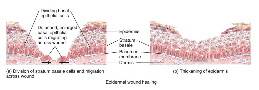 <p>the central portion of  the wound usually extends deep down to the dermis, whereas the wound edges usually involve only superficial damage to the epidermal cells; repaired by enlargement and migration of basal cells, contact inhibition, and division of migrating and stationary basal cells; epidermal growth factor stimulates basal cells to divide and replace the ones that have moved into the wound</p>