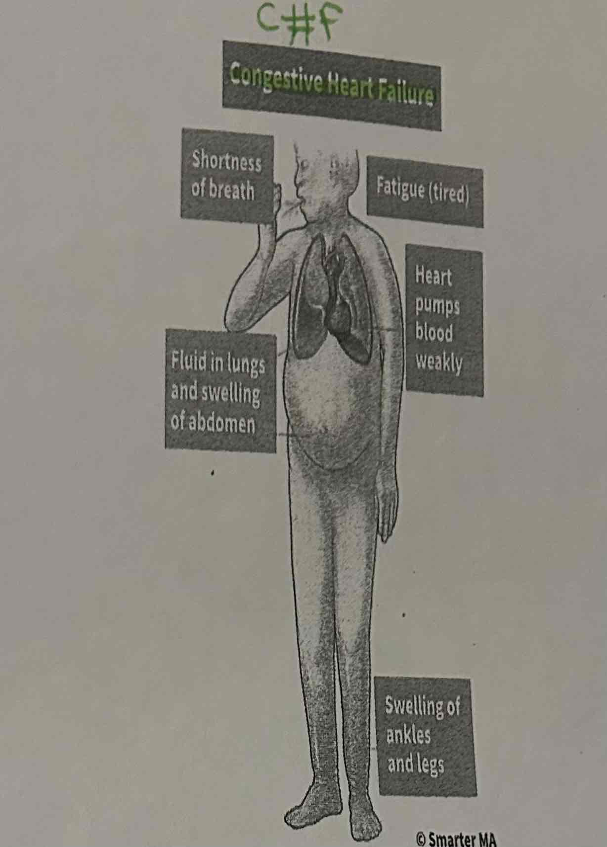 <p><span>Congestive heart failure (CHF) is a condition in which the heart is unable to pump enough blood to meet the body's needs (the heart pumps too weakly). CHF leads to a build-up of fluid in the body, which can cause a variety of symptoms.</span></p>