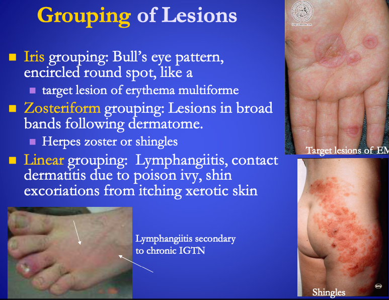 <p><span><strong>[...]</strong></span> grouping:&nbsp;</p><ul><li><p>Lymphangiitis</p></li><li><p>contact dermatitis due to poison ivy</p></li><li><p>shin excoriations from itching xerotic skin&nbsp;</p></li></ul><p></p>