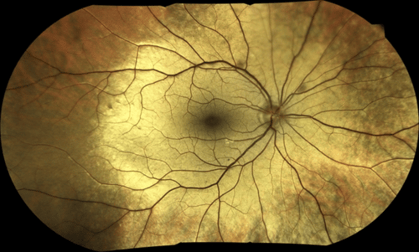 <p>Mizuo-Nakamura phenomenon&nbsp;= fundus is unremarkable in the dark-adapted state, but has a yellow iridescent (golden) sheen after light exposure</p>