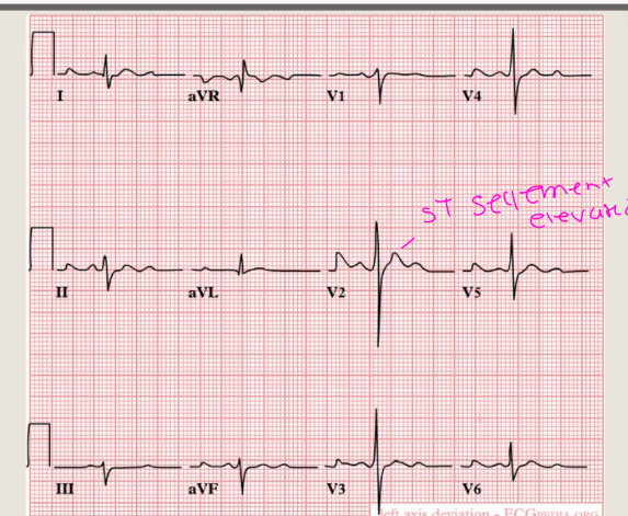 <p>Shows LV hypertrophy</p><p>with ST segment</p><p>elevation, left atrial</p><p>enlargement, and</p><p>possibly ventricular</p><p>tachycardia</p>