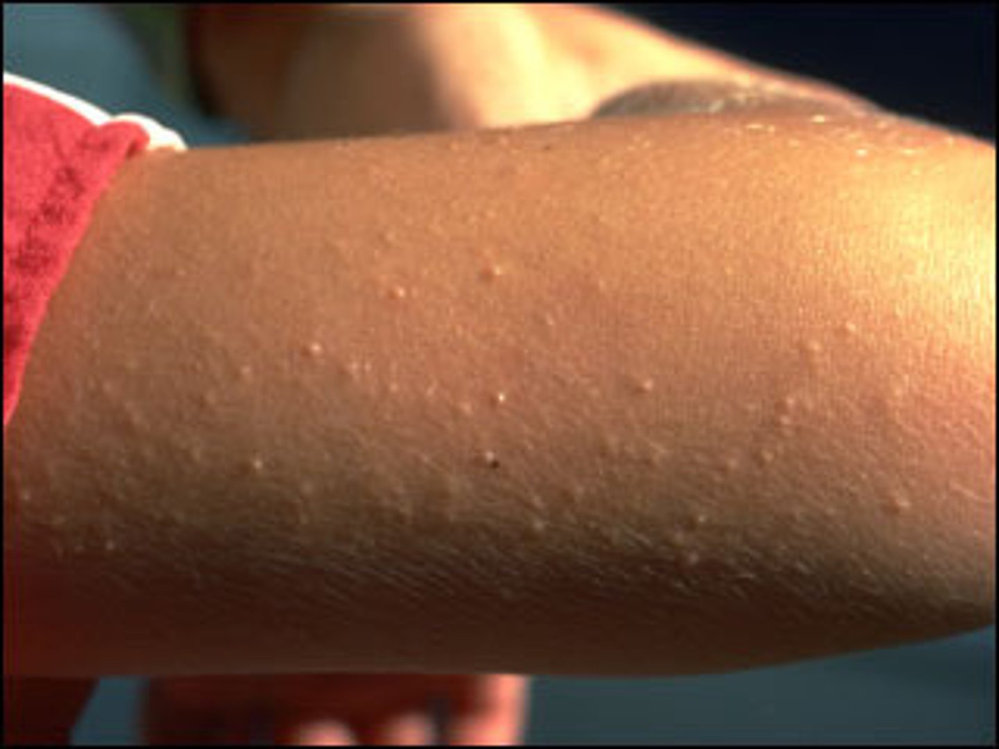 <p>Redness and bumpiness common on the cheeks or upper arms; it is caused by blocked hair follicles. The patches of irritation are accompanied by a rough texture and small pinpoint white milia. mildly pruritic that looks like "gooseflesh."; the rash appears as small, pinpoint, follicular papules on a mildly erythematous base. Is a benign condition that resolves by adulthood</p>