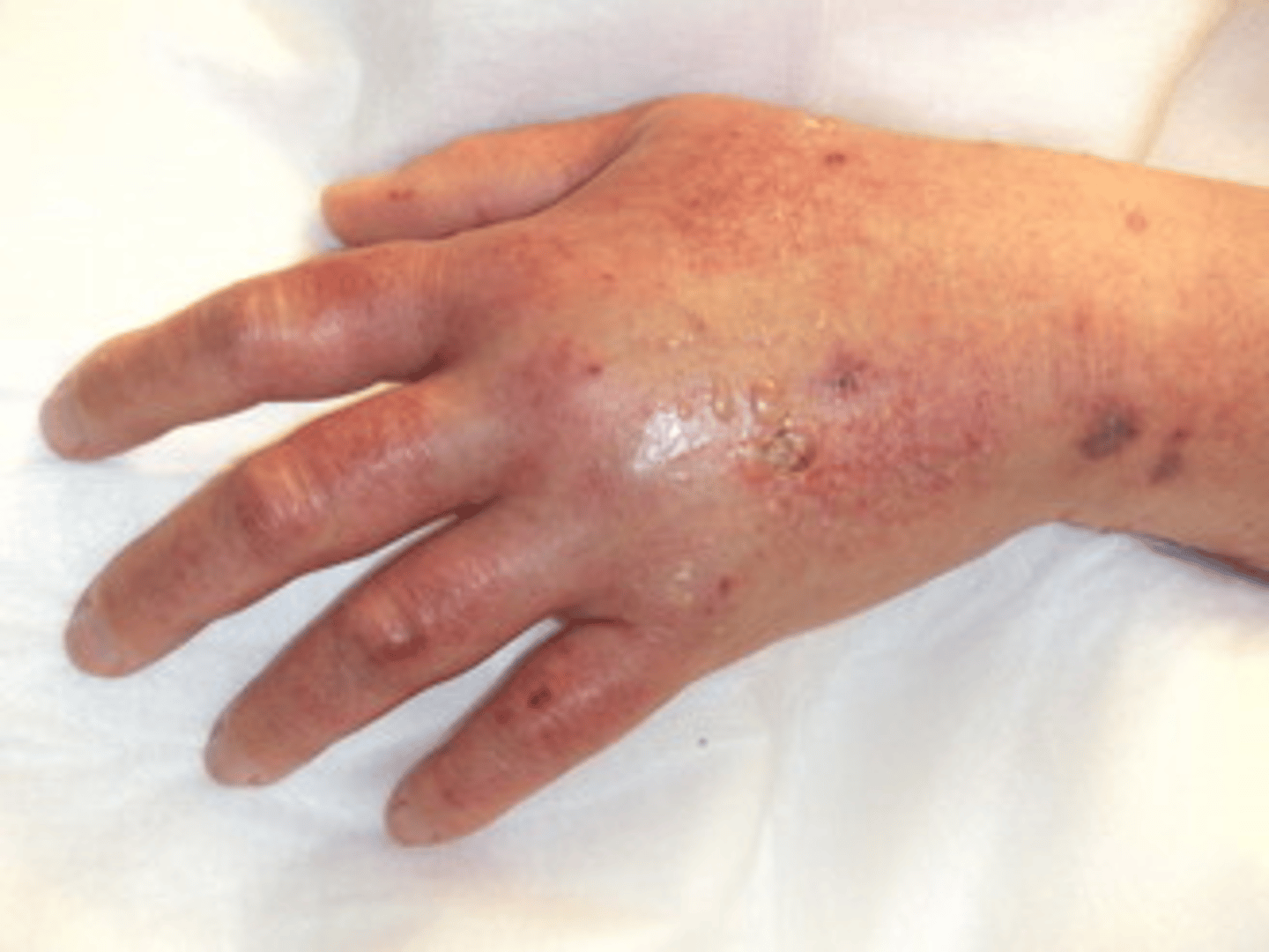 <p>Definition:When IV fluid flows into surrounding tissues</p><p>Presents as edema in affected extremity, very painful</p><p>Stop the infusion, remove the IV, elevate the extremity</p>