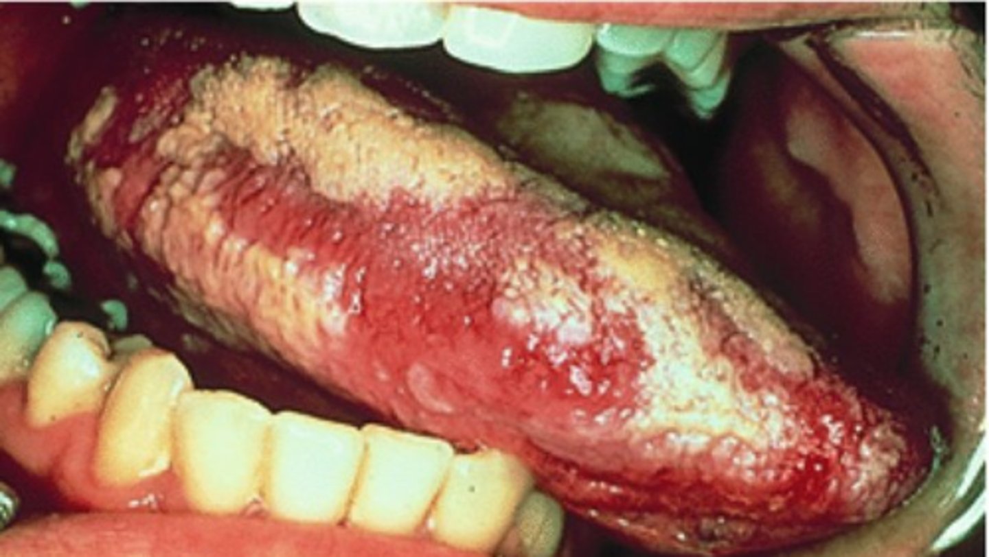 <p>well demarcated white plaque that CANNOT be wiped off</p><p>• high risk sites: 1) lateral/ventral tongue, 2) floor of mouth/retromolar pad, 3) tonsillar pillar/soft palate (24-42% dysplasia)</p><p>• unknown cause</p><p>• must biopsy after 14 days</p><p>• Population: males over 50</p>