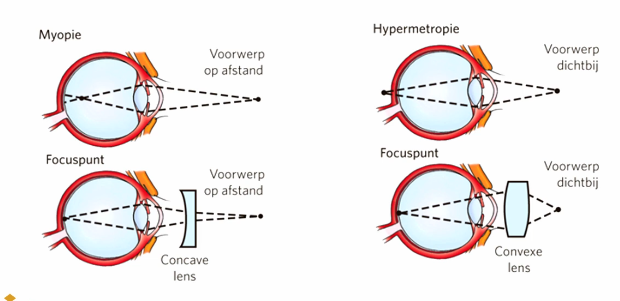<ul><li><p><strong>mytopie </strong>= bijziend. De&nbsp;<span>lens is te bol/oog te lang → hierdoor is de&nbsp;breking te sterk:<u> het brandpunt ligt vóór de fovea.</u> De lens<strong> </strong>kan niet genoeg uitrekken, waardoor er onvoldoende licht op het netvlies valt. Dit is op te lossen met concave (-) lens.</span></p></li><li><p><strong>hypermetropie </strong>= verziend. De lens is te vlak/oog te kort → hierdoor is de breking te zwak:<u> het brandpunt ligt achter de fovea.</u> De lens kan niet voldoende sferisch worden. Dit is te verhelpen met convexe/bolle lenzen (+)</p></li><li><p><strong>astigmatisme </strong>=&nbsp;<span>Cornea niet geheel bolvormig → hierdoor zie je wazig &amp; niet helemaal recht. Dit wordt gecorrigeerd met een cylinder.</span></p></li><li><p><span><strong>presbyopie </strong>= verziendheid die met de leeftijd ontstaat. De lens wordt harder naarmate je ouder wordt → hierdoor kan die niet sferisch genoeg worden om scherp te stellen voor dichtbij</span></p></li><li><p><span><strong>maculadegeneratie </strong>=&nbsp;</span>Wordt veroorzaakt door uitval van de kegeltjes in de macula (fovea met klein gebied eromheen) → het zicht is zwart &amp; vervormd. Veel bij rokers.</p></li><li><p><strong>glaucoom </strong>= het perifere gezichtsvermogen wordt minder door het falen van M-cellen (magnocellen = staafjes) door te hoge druk in het oog → hierdoor krijg je tunnelvisie</p></li><li><p><strong>staar </strong>= vertroebeling van de lens → hierdoor zie je wazig. Dit wordt vaak veroorzaakt door ouderdom of suikerziekte</p></li></ul><p></p><p></p>