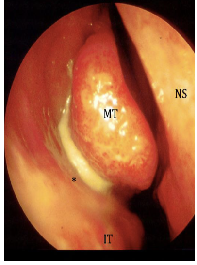 <p>Most commonly viral but can also be bacterial infection.</p><p>Diagnosed by nasendoscopy to see if [pus discharge from sinus drainage to the nasal cavity.</p><p><span style="font-size: calc(var(--scale-factor)*27.98px)">Complications: </span><span style="font-size: calc(var(--scale-factor)*27.96px)">Meningitis, Osteomyelitis, </span><span style="font-size: calc(var(--scale-factor)*27.98px)">Orbital abscess and </span><span style="font-size: calc(var(--scale-factor)*27.96px)">cellulitis</span></p><p><span style="font-size: calc(var(--scale-factor)*27.96px)">Diagnosed by blood test or CT scan if severe complications.</span></p><p><span style="font-size: calc(var(--scale-factor)*27.96px)">Treated by Nasal saline irrigation or intranasal steroids if mild, sever symptoms treat with broad-spectrum antibiotics.</span></p>