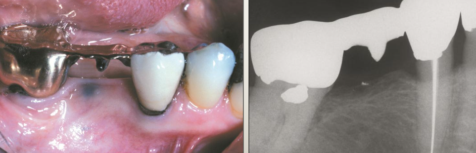 <p>What is the management of amalgam tattoos?</p>