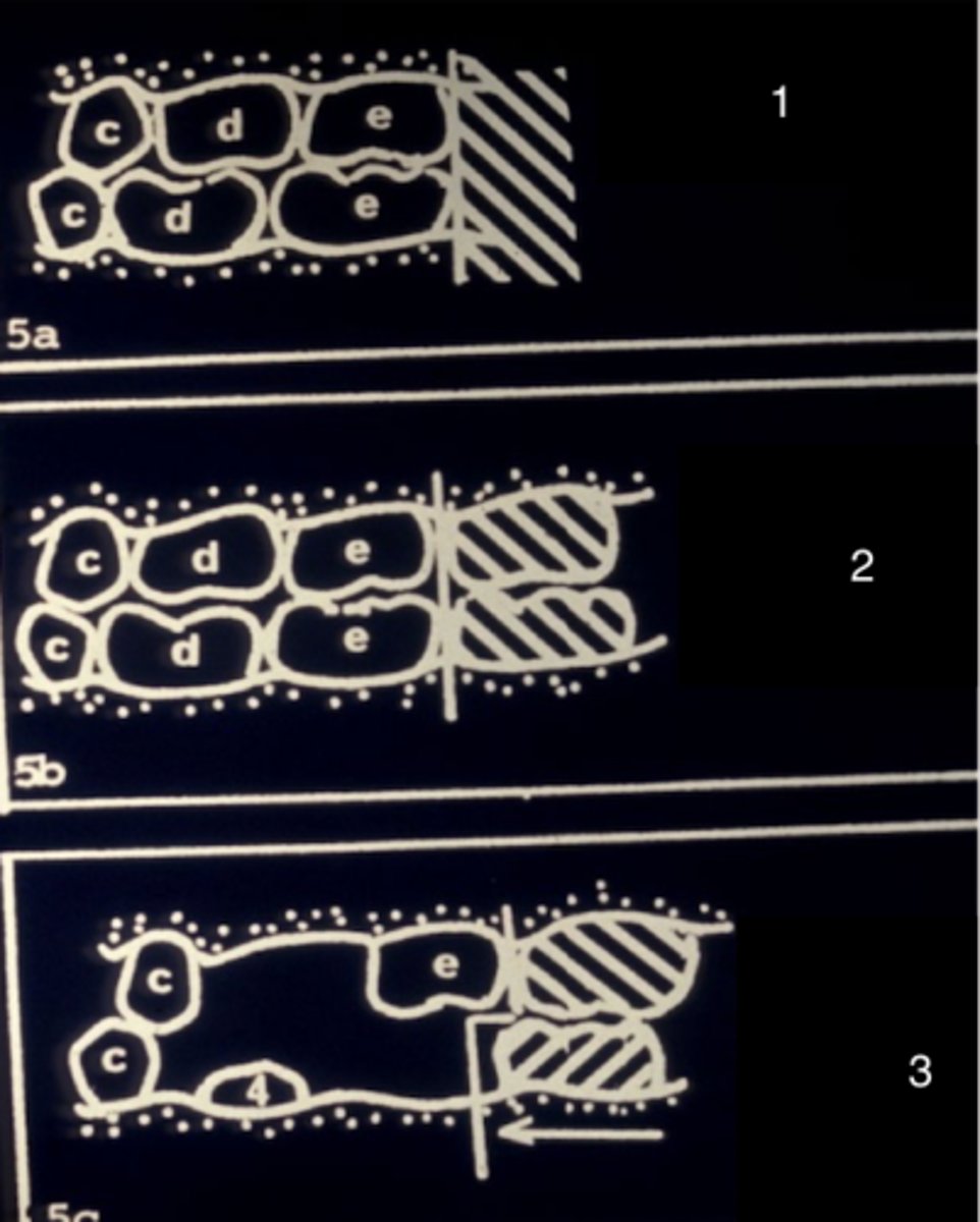 <p>Picture 3 shows a late mesial shift due to what occuring? </p>