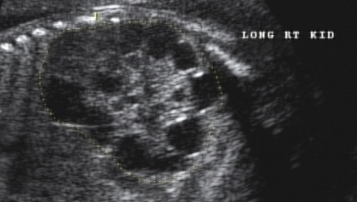<ul><li><p>renal tissue replaced by cysts</p></li><li><p>Renal A may be hypoplasia or absent</p></li><li><p>Bilateral Multicystic = oligohydramnios and absent bladder = lethal</p></li><li><p>Unilateral = normal AFV and bladder</p></li></ul><p></p>