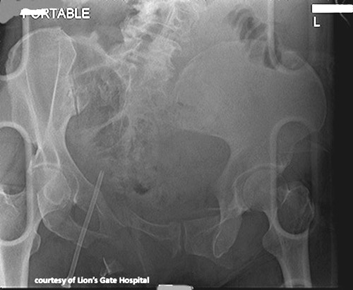<p>What generates a combined mechanical pelvic fracture?</p>