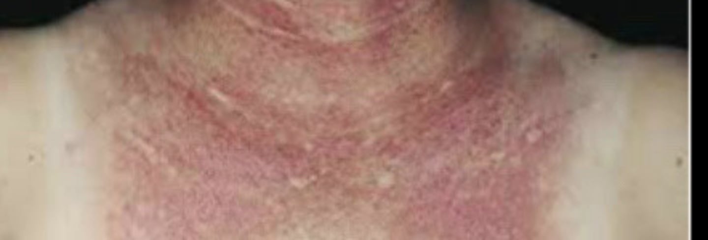 <p>Photosensitivity</p>