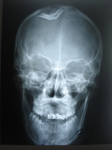<p>Depressed fracture </p>