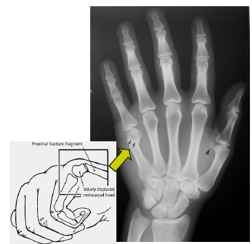 metacarpal necks, 4/5 in amateur 2/3 in pros