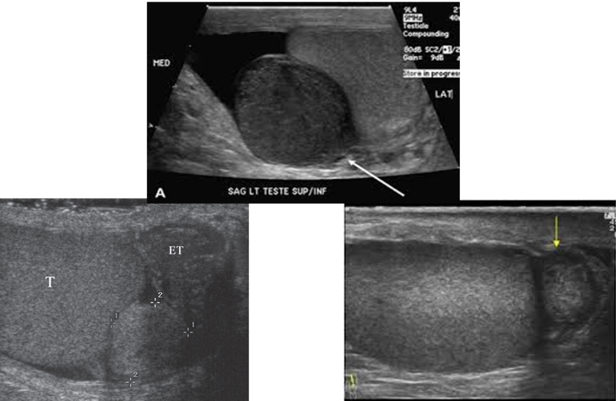 <p>What does the following describe?</p><p>•Usually involve epididymis, most often tail</p><p>•In adults, usually benign, but in children more frequently malignant</p><p>•Sonographically – Unilateral, solitary, well defined, round or oval, measuring more than 5 cm diameter. May be hypoechoic</p>