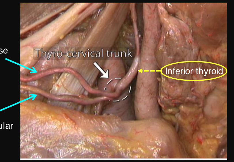 <p>inferior thyroid artery which supplies the thyroid gland and larynx</p>