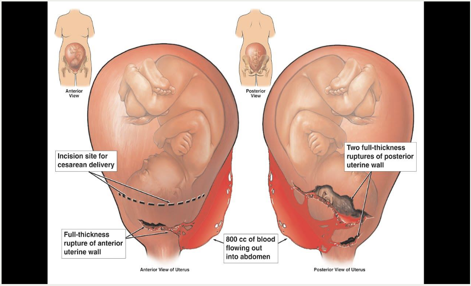 <p><strong>tear through the full thickness of the uterine wall</strong>, often including the <strong>endometrium, myometrium, and sometimes serosa</strong>, which can lead to <strong>fetal and maternal compromise</strong>.</p><p><strong>Risk factor</strong></p><ul><li><p>VBAC</p></li><li><p>after uterine surgery</p></li><li><p>multiparity</p></li></ul><p>fetus can be ejected inot the abdominal cavity</p><p></p><p><strong>signs and symptoms</strong></p><ul><li><p>abnormal FHR tracing</p></li><li><p>loss of fetal station</p></li><li><p>sudden sharp abdominal pain - ripping / tearing</p></li><li><p>hemorrhage / hypovolemic shock</p></li></ul><p></p>