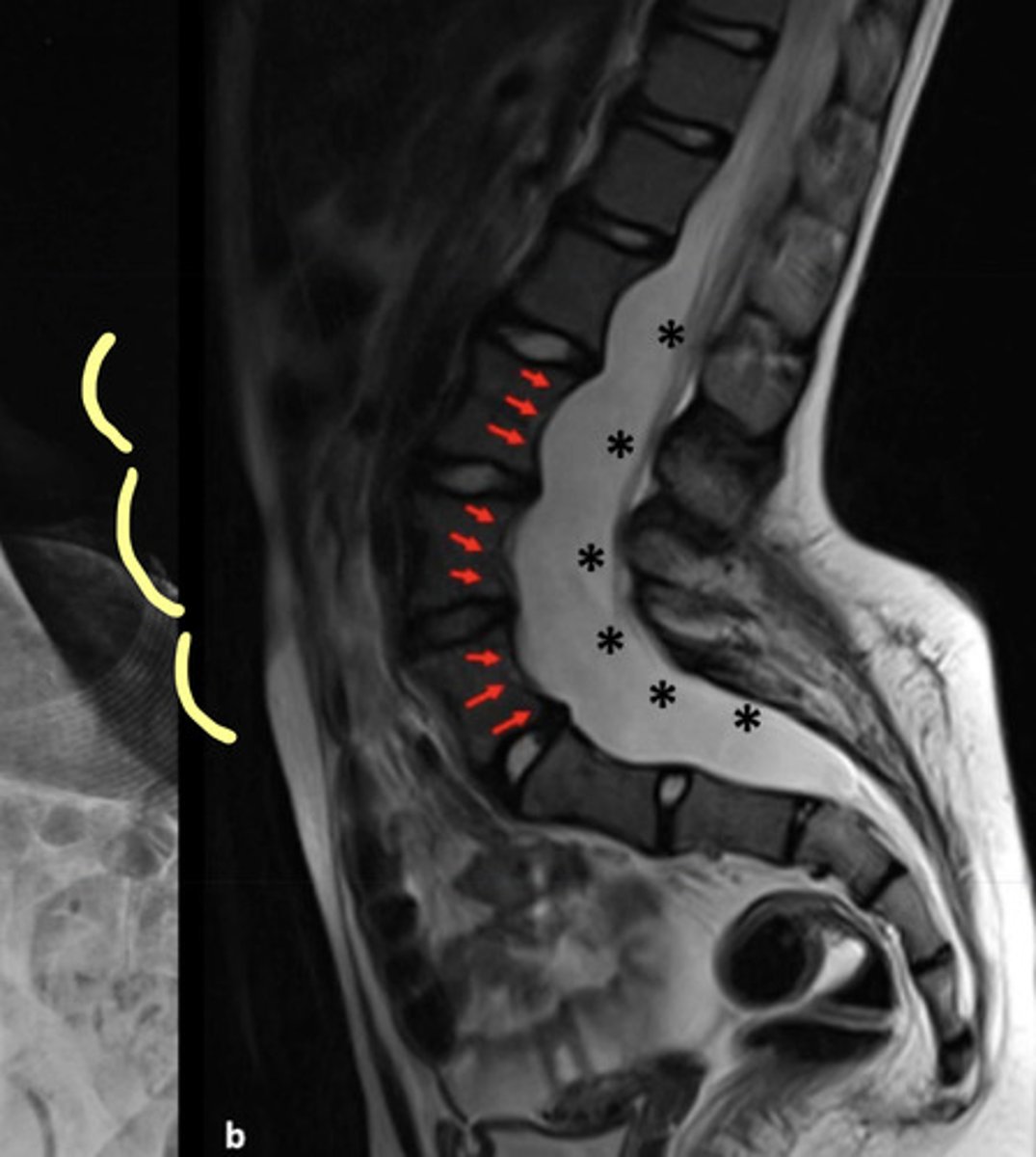 <p>Ribbon-shaped ribs and posterior vertebral body scalloping</p><p>Curves must be monitored carefully since they can collapse and rapidly produce paralysis</p>