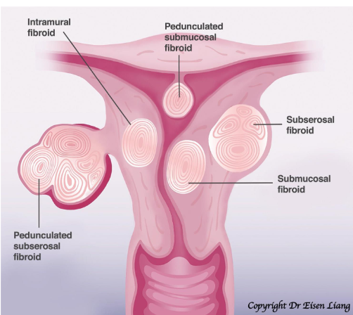 <p><span>Benign tumours of the myometrium.<br>Caused by proliferation of a mixture of smooth muscle cells and fibroblasts</span></p>