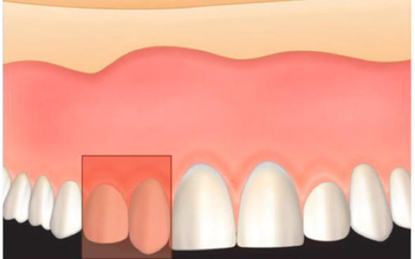 <p>Two teeth swapped position</p>