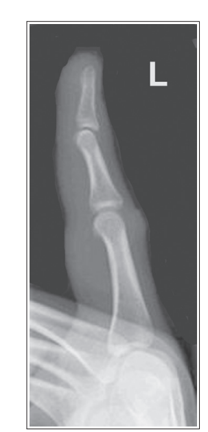 <p>What’s wrong with this oblique finger projection?&nbsp;</p>