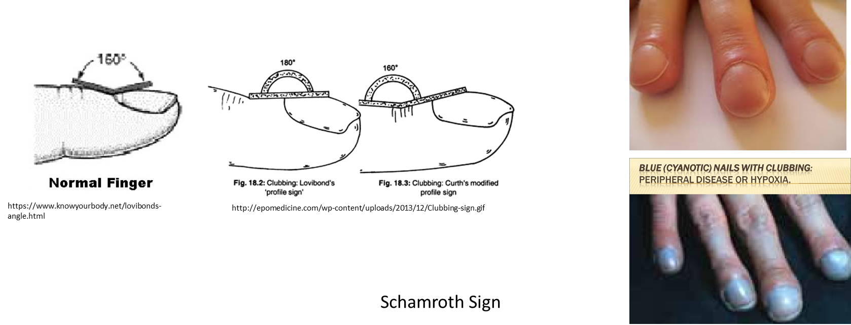 <p>nail clubbing</p>