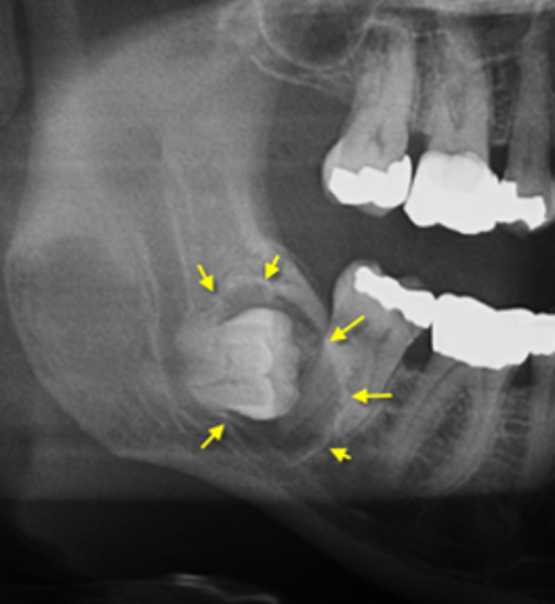 <p>what is your diagnosis?</p><p>- Well defined and corticated lesion</p><p>- Radiolucent</p><p>- Pericoronal (associated with crown of unerupted tooth)</p><p>- Usually unilocular</p><p>- Osseous expansion- of outer cortical boundary of the involved jaw</p>