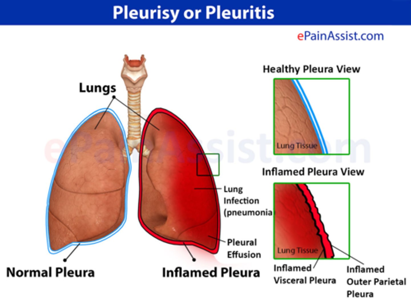 <p>inflammation of pleura when irritated by, for example, a lung cancer cell</p>