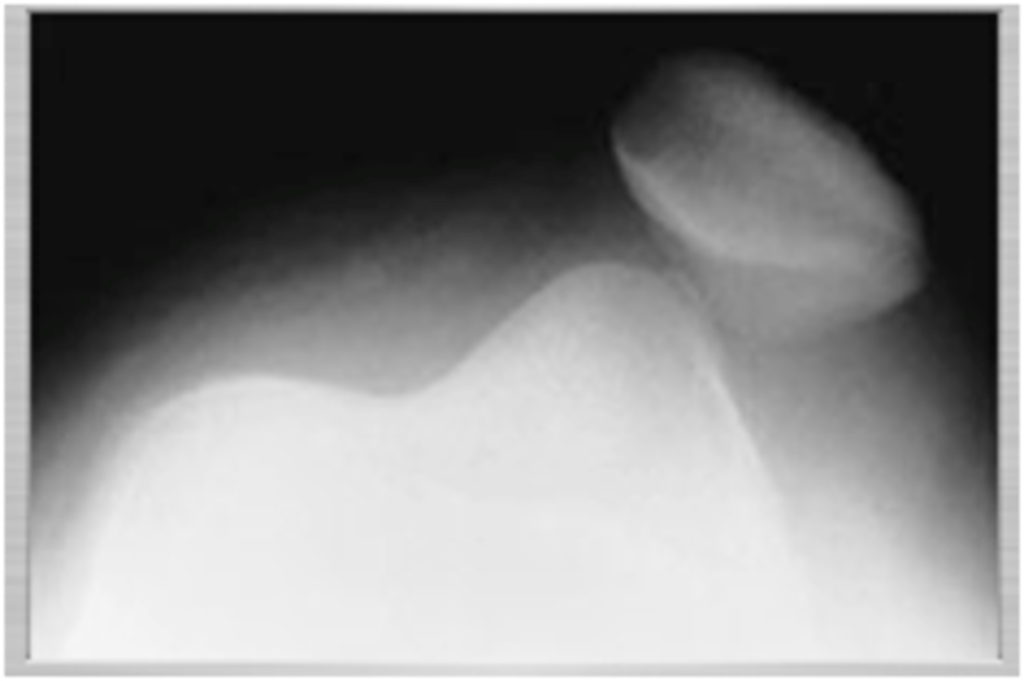 <p>lateral dislocation</p>