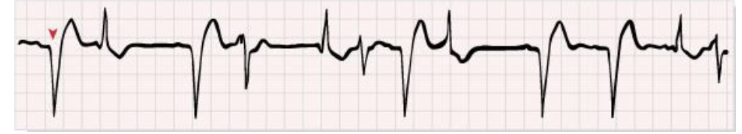 <p>wide QRS complexes with abnormal shapes and durations </p><p></p><p>can be occasional, bigeminy, trigeminy, quadrigeminy, or have runs of PVC </p>