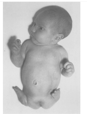 <p>What condition is this?</p><p>Rare congenital deformity, the hands and feet are attached close to the trunk. Limbs are closely underdeveloped are absent.</p><p>Side effect of thalidomide</p>