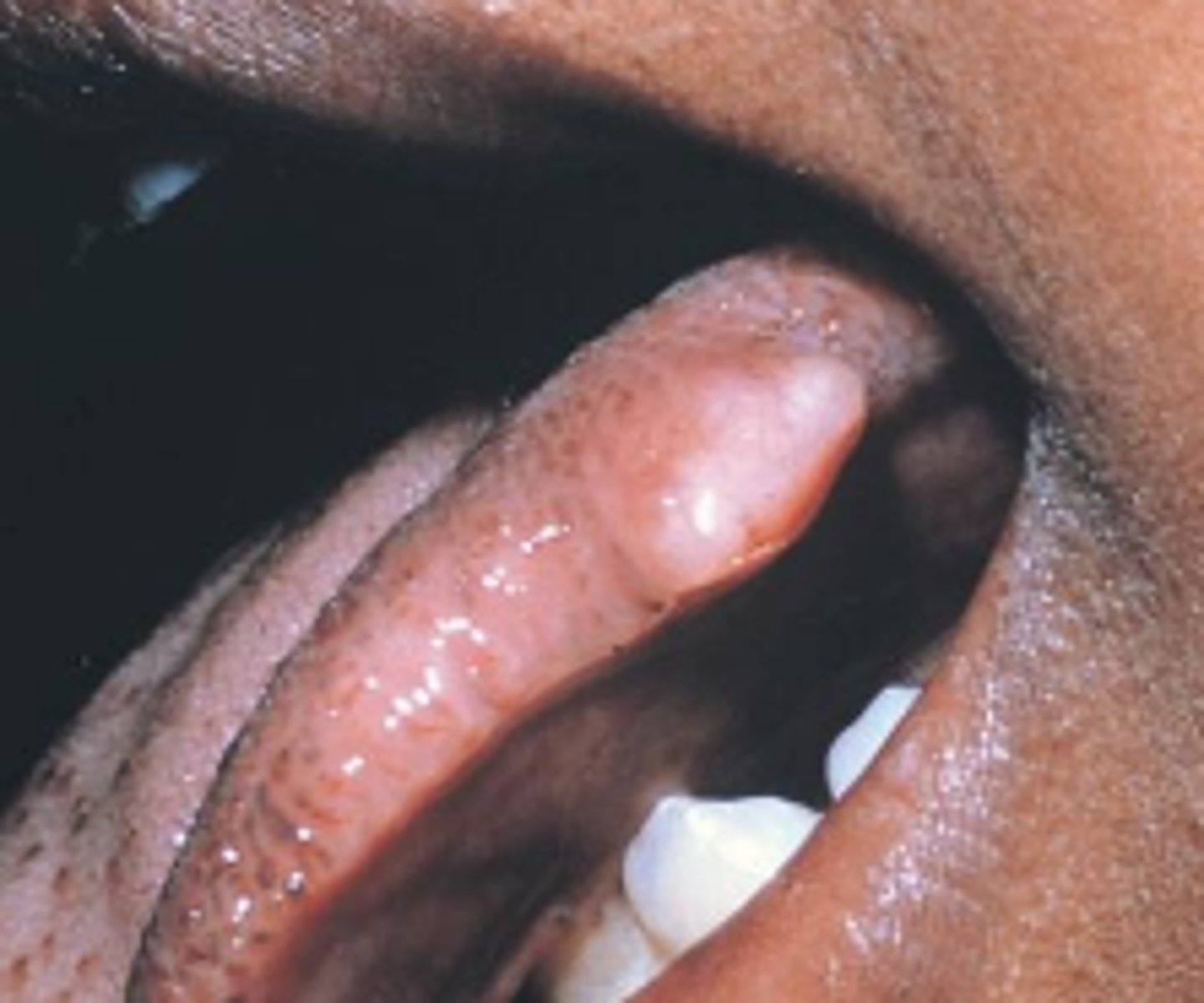 <p>______ is a benign neural neoplasm of Schwann cell origin and is uncommon. Its clinical features is slow-growing, encapsulated tumor that typically arises in association with a nerve trunk, its asymptomatic, the tongue is the most common location for oral schwannomas and can arise centrally.</p>