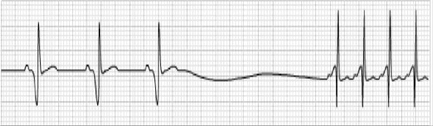 <p>What does the ECG show?</p>