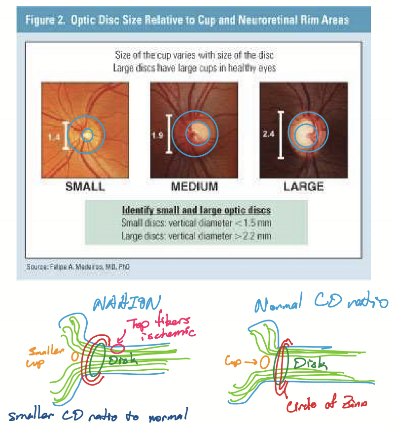 <p>Having a <strong>small</strong> crowded disc: nerve fibers packed into small disc are thicker and increases the distance O2 needs to diffuse, thus increases risk of ischemia. </p>