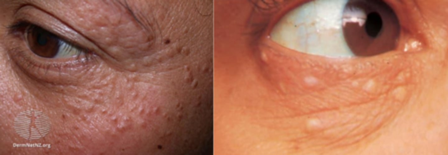 <p>originates in deep dermis tissue</p>