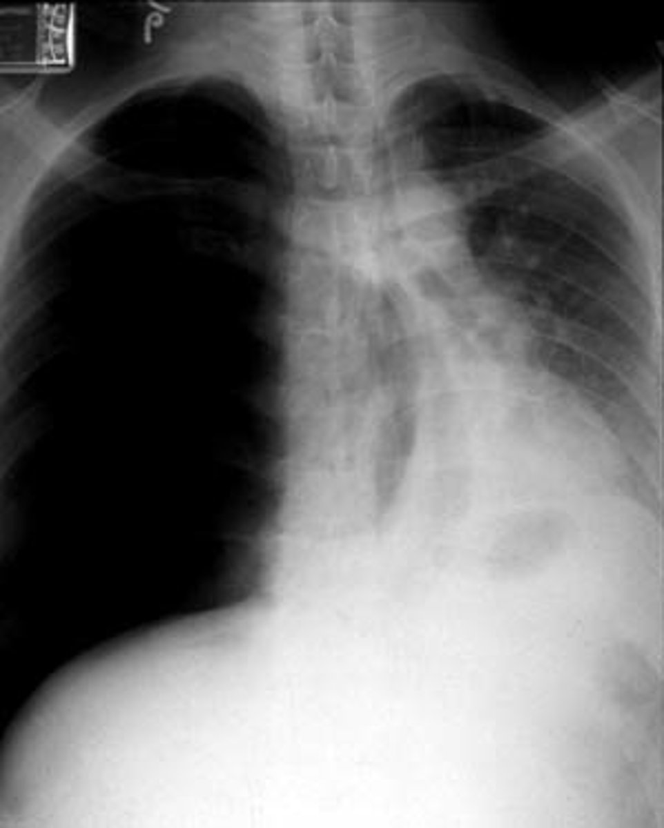 <p>notice the trachea being pushed away </p>